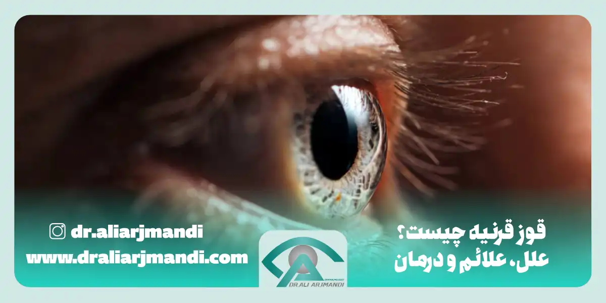 قوز قرنیه چیست؟ علائم، علل و جدیدترین درمان در سال 1404