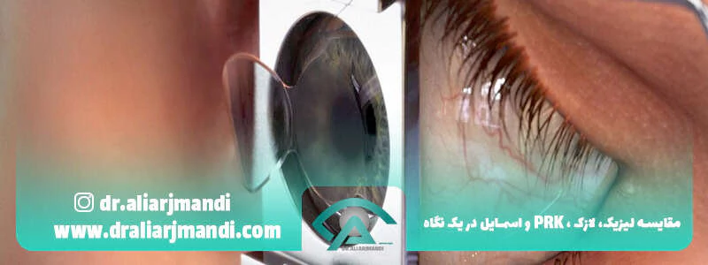 مقایسه لیزیک، لازک، PRK و اسمایل در یک نگاه