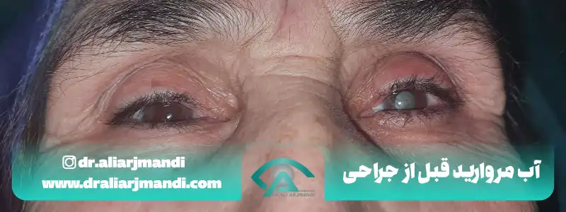 آب مروارید قبل از جراحی