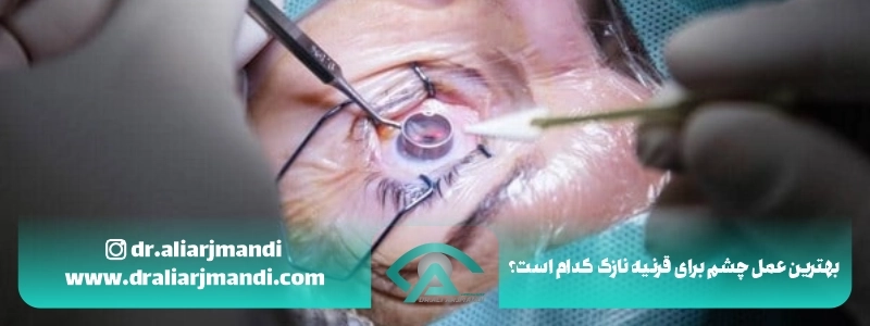 بهترین عمل چشم برای قرنیه نازک کدام است؟