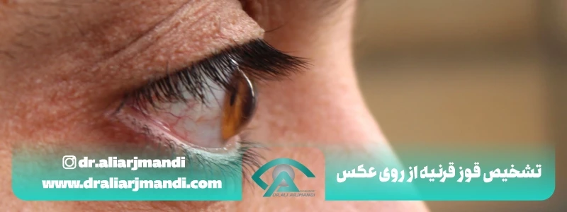 تشخیص قوز قرنیه از روی عکس