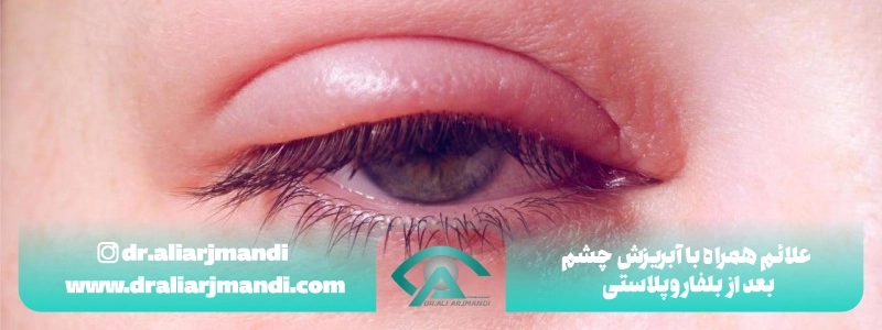 علائم همراه با آبریزش چشم بعد از بلفاروپلاستی