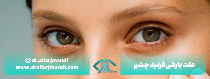 علت پارگی قرنیه چشم