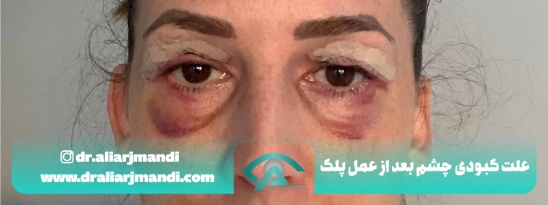 علت کبودی چشم بعد از عمل پلک