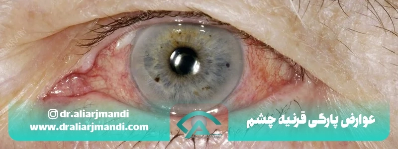 عوارض پارگی قرنیه چشم