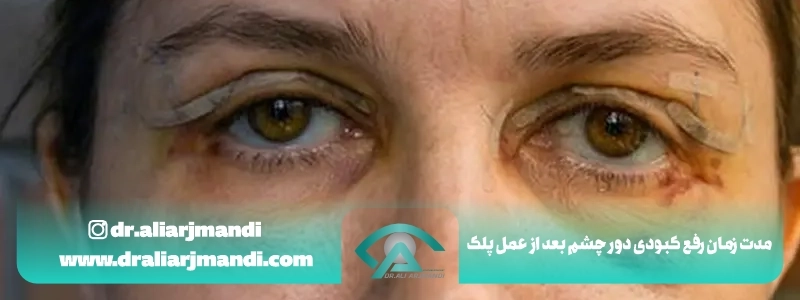 مدت زمان رفع کبودی دور چشم بعد از عمل پلک