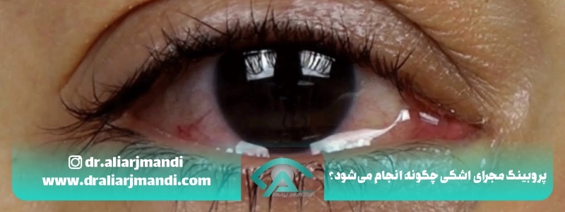 پروبینگ مجرای اشکی چگونه انجام می_شود؟