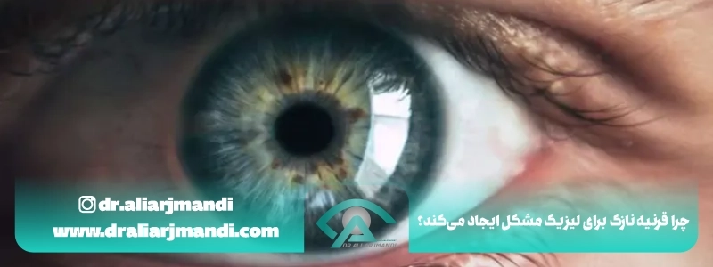 چرا قرنیه نازک برای لیزیک مشکل ایجاد می کند؟